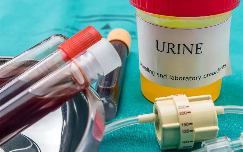 Do You Ever Check On Your Urine?